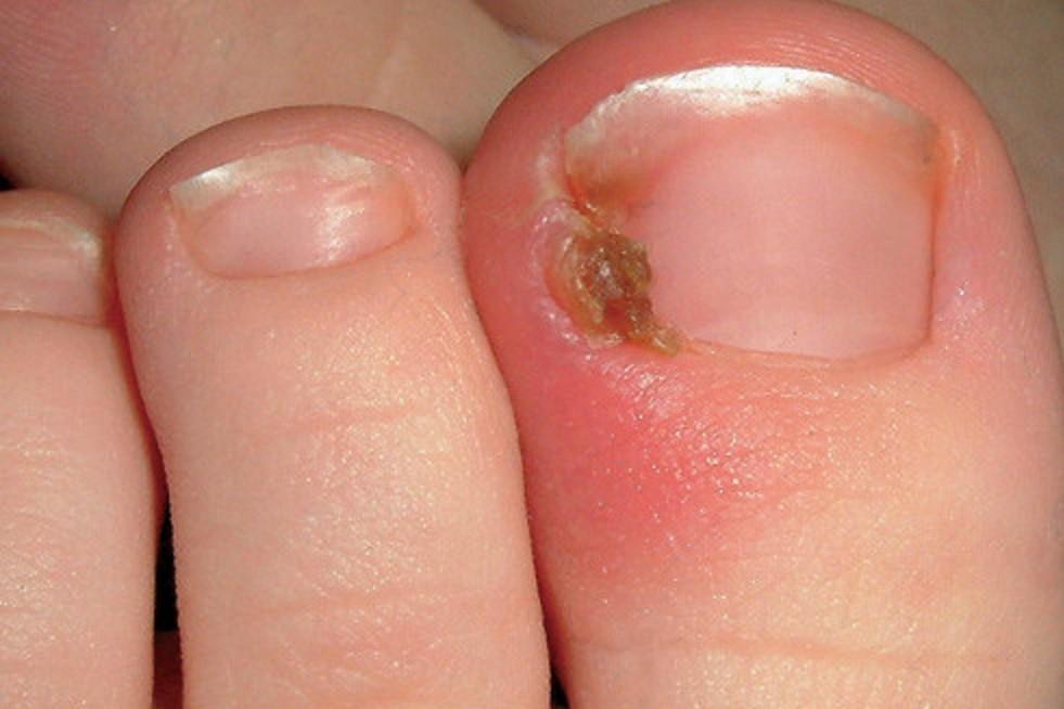 Ingrown Toenail Causing Swelling