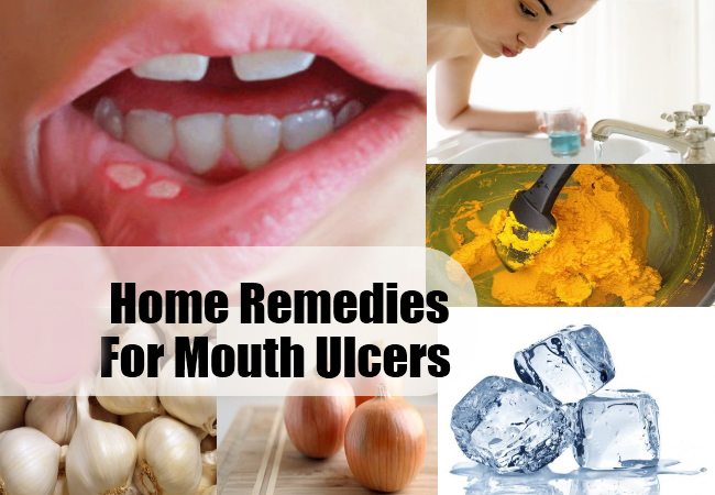 Perfect-Home-Remedies-for-Mouth-Ulcers