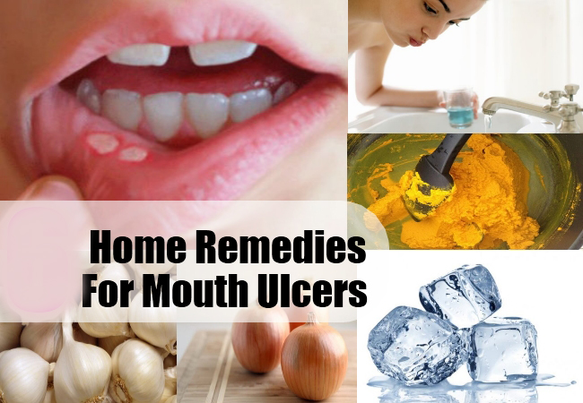 Perfect Home Remedies For Mouth Ulcers Life Health Max