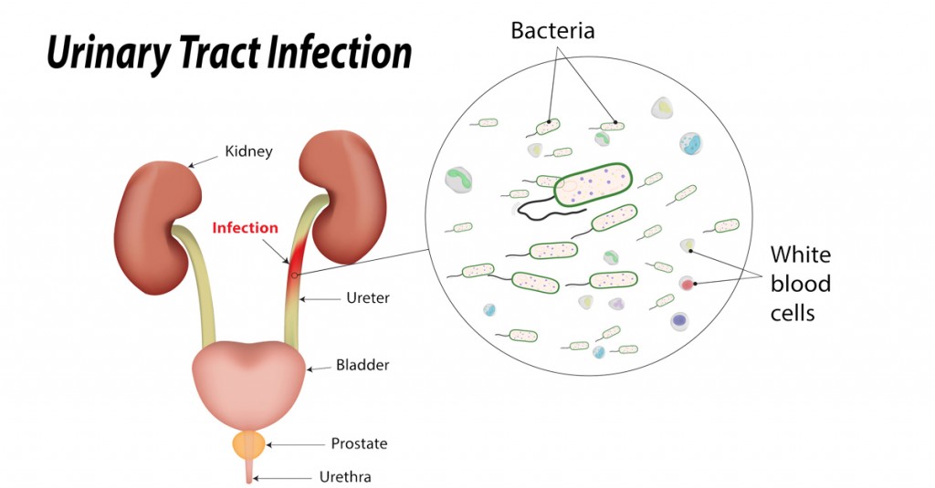 Urinary Tract Infections Utis Symptoms And Causes Life Health Max 2425