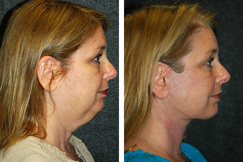 mini-facelift-before-and-after