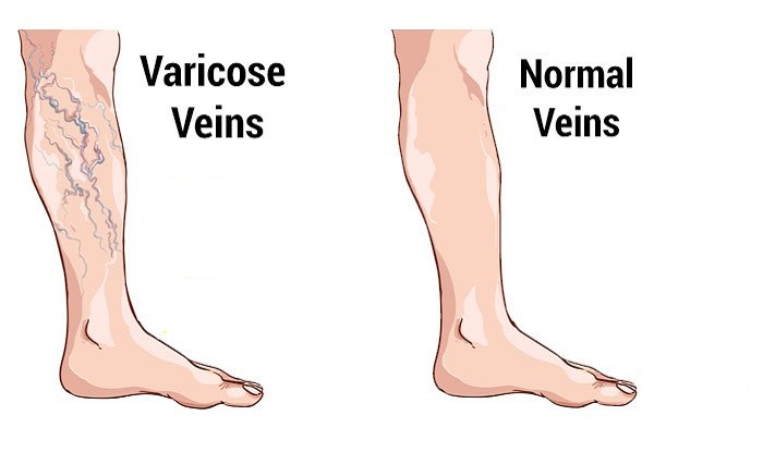5 Options for Surgery for Varicose Veins