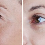 cosmetic eyelid surgery