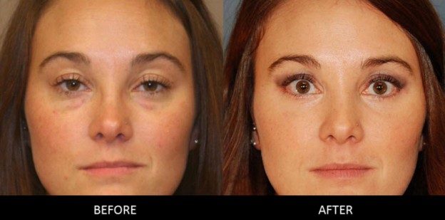 What To Expect From Blepharoplasty?