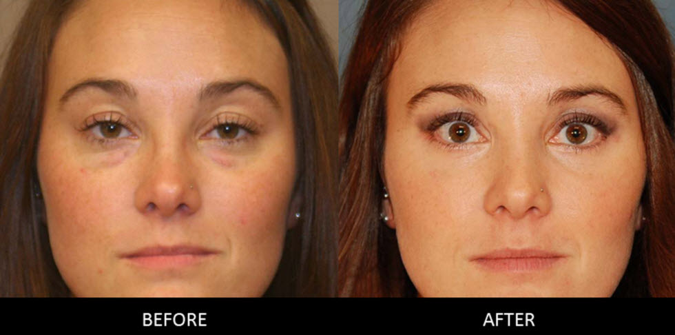 Expect-from-Blepharoplasty