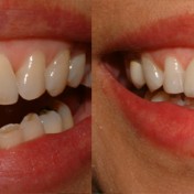 Cosmetic-Dentistry-in-Toronto-area