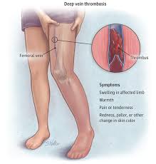 Ways-to-treat-Deep-Vein-Thrombosis