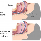 What-Causes-Snoring-And-What-You-Can-Do-About-It