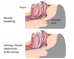 What Causes Snoring And What You Can Do About It - Life Health Max