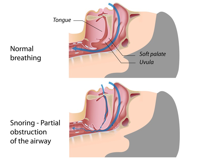 what-causes-snoring-and-what-you-can-do-about-it-life-health-max