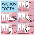 Wisdom-Teeth