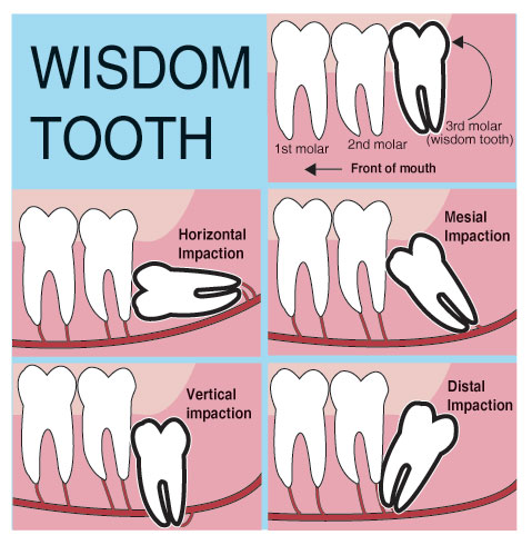 Wisdom-Teeth