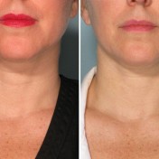 get rid of neck wrinkles