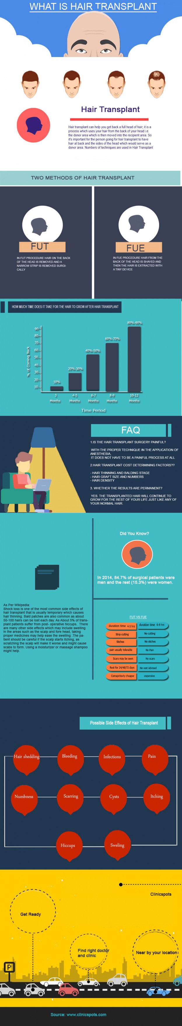 What Is Hair Transplant?