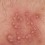 Causes of Genital Herpes Infection