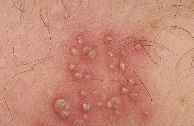 Causes Of Genital Herpes Infection