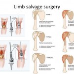 Limb-Salvage-Surgery