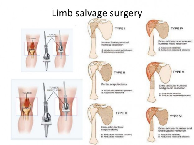 Overview Of Limb Salvage Surgery