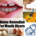 Perfect-Home-Remedies-for-Mouth-Ulcers