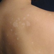 White-Spots-on-the-Skin