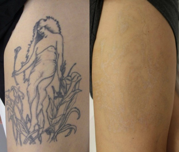 Dorian Davis’s Laserless Tattoo Removal Guide – Review