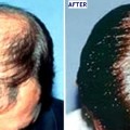 hair transplant