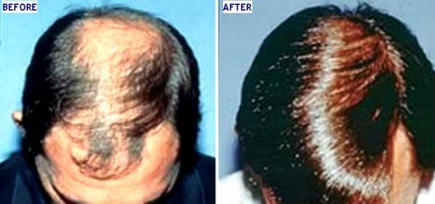 Hair Transplantation Surgery