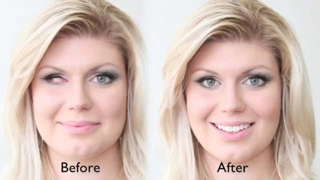 The Benefits Of Prosthetic Eyes For A One-Eyed Patient