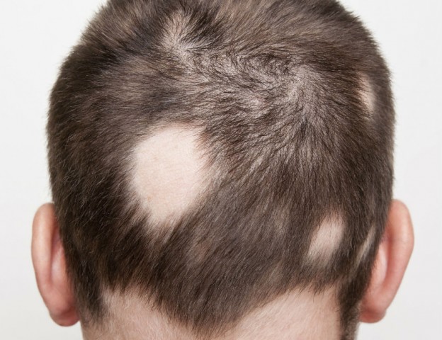 Getting To The Root Of Alopecia Areata