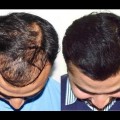 Hair-Transplant