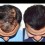 Hair Transplant Hairline Design & High Density