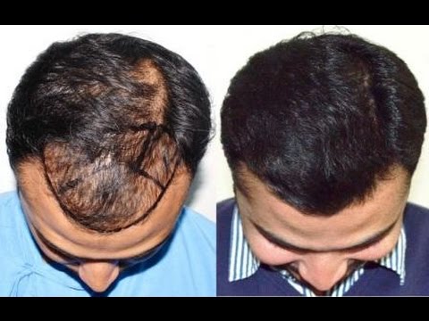 Hair-Transplant