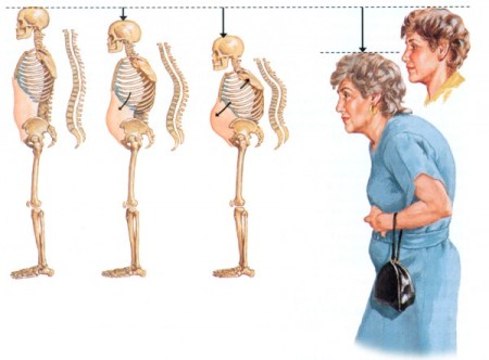 Osteoporosis-Signs