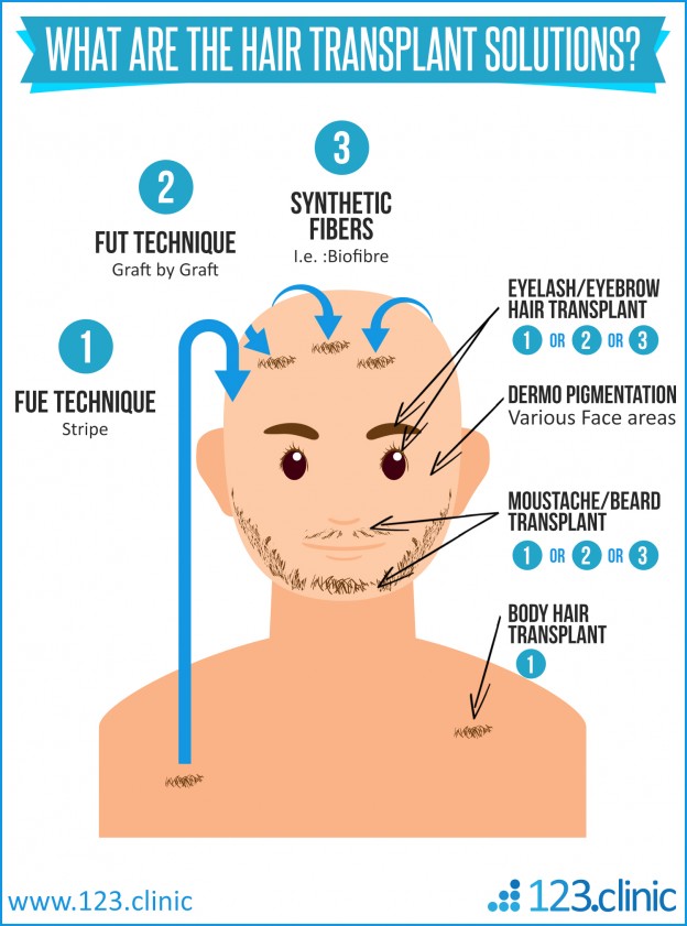 Male Hair Transplant 1000 Grafts (Fue/Fut Technique)