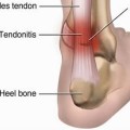 Tendinitis vs