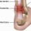 Tendinitis vs. Tendinosis: What’s the Difference?