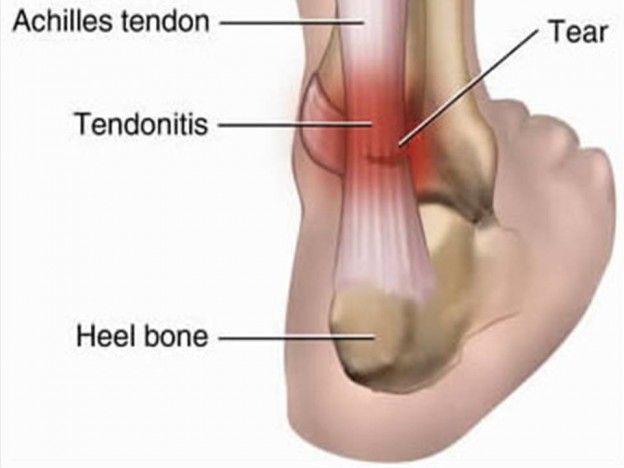 Tendinitis vs. Tendinosis: What’s the Difference?