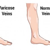 5 Options for Surgery for Varicose Veins