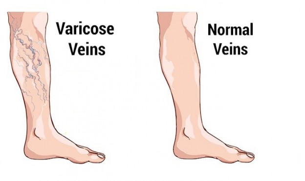 5 Options For Surgery For Varicose Veins