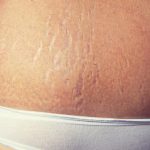 Home Treatment to Prevent Stretch Marks