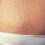 Home Treatment to Prevent Stretch Marks
