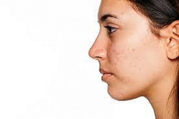 Tips on how to treat ACNE