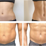 Inmode Evolve - Shed Unwanted Fat from the Body