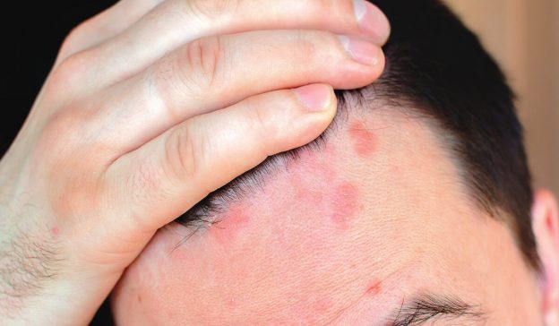 How To Deal With Scalp Sores?