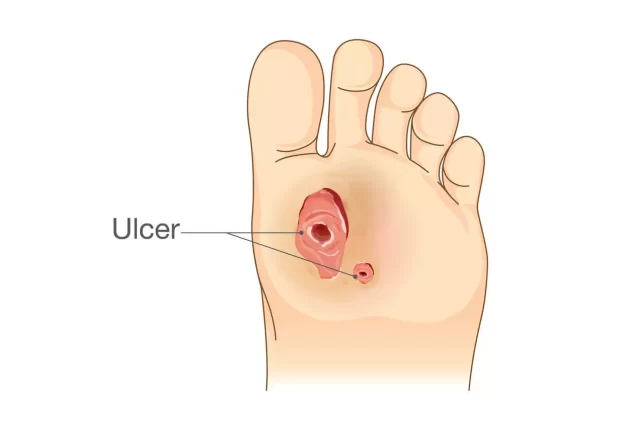 How Does A Podiatrist Treat A Diabetic Ulcer?