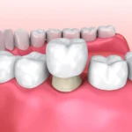 Ceramic Teeth Cap