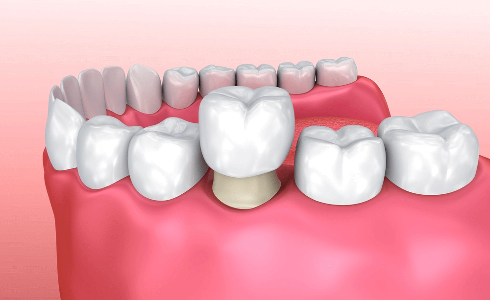 8 Reasons You Should Consider A Ceramic Teeth Cap